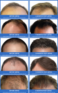ARTAS-Before-and-After-Hair-Transplant-Long-Island-NY